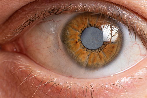 We treat eye cataract